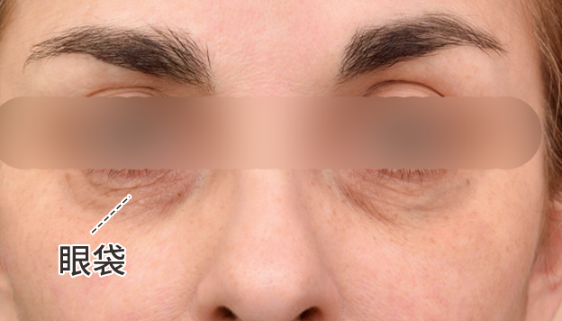 去眼袋手术
