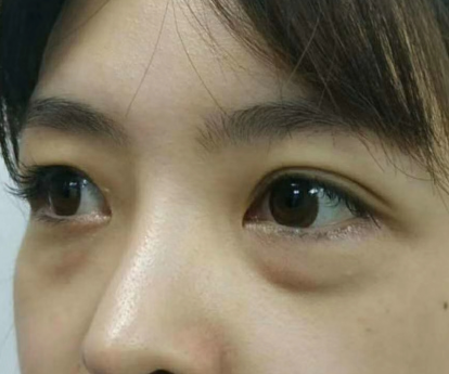 去眼袋手术