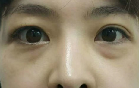 去眼袋手术