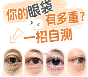去眼袋手术