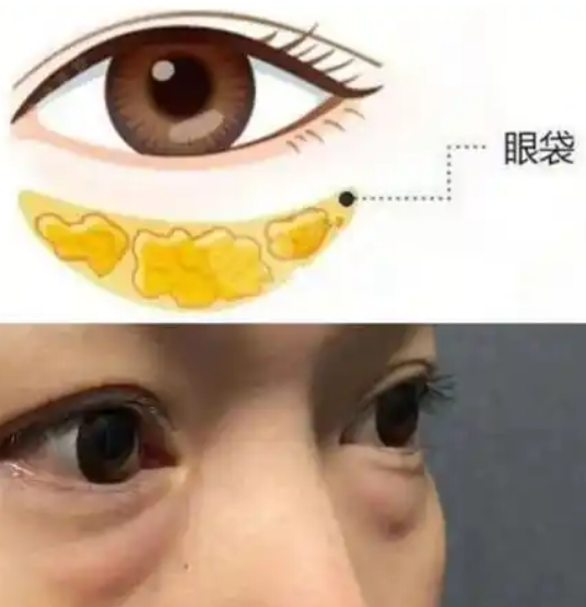 去眼袋手术