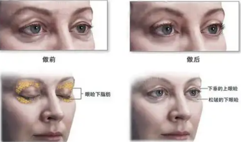 去眼袋手术