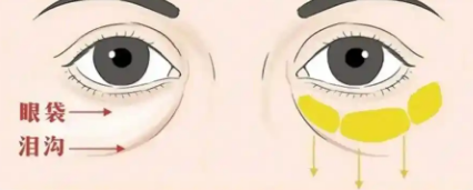 去眼袋手术