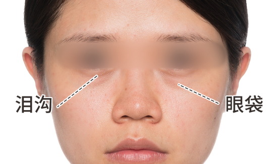 眼袋