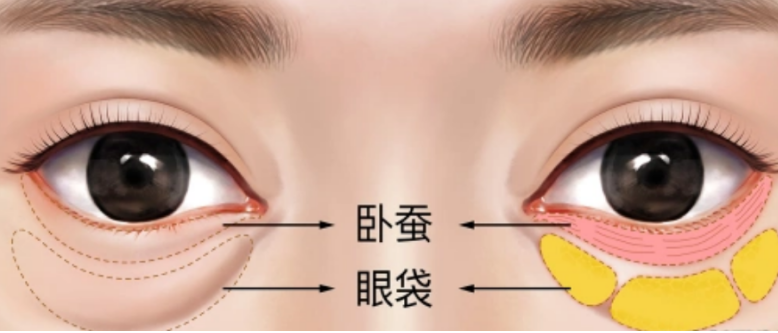 眼袋
