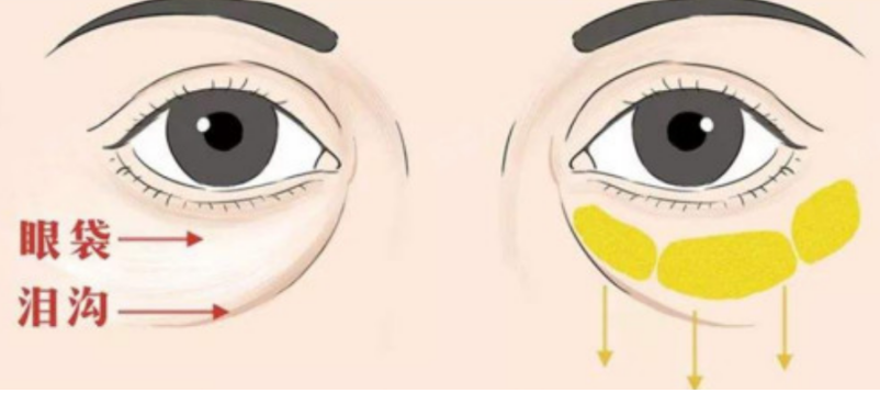 眼袋
