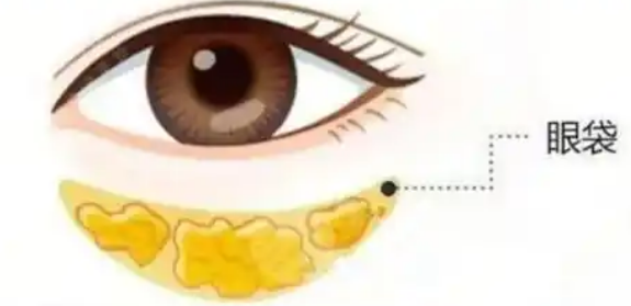 去眼袋手术