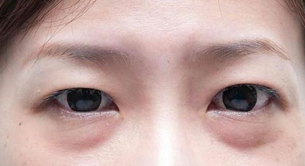 眼袋