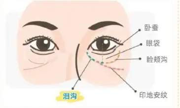 去眼袋手术