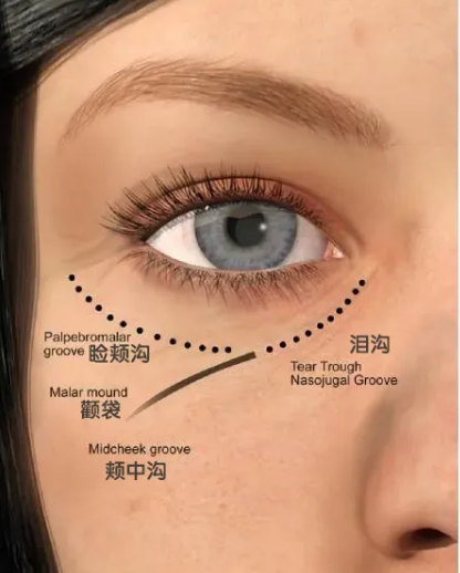 去眼袋手术