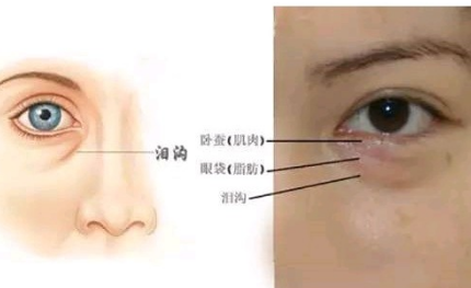 去眼袋手术