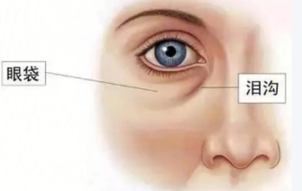 去眼袋手术