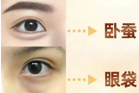去眼袋手术