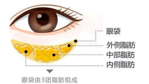 去眼袋手术