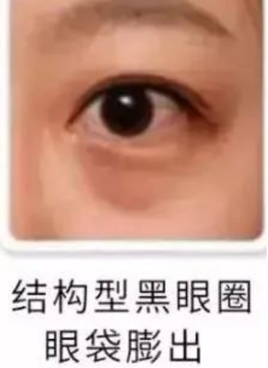 去眼袋手术