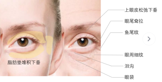 去眼袋手术