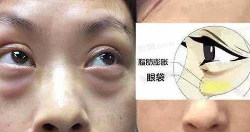 去眼袋手术