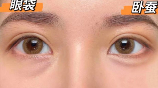 眼袋