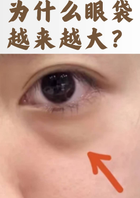去眼袋手术