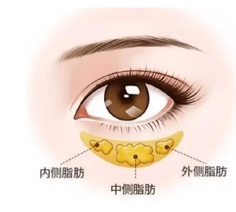 去眼袋手术