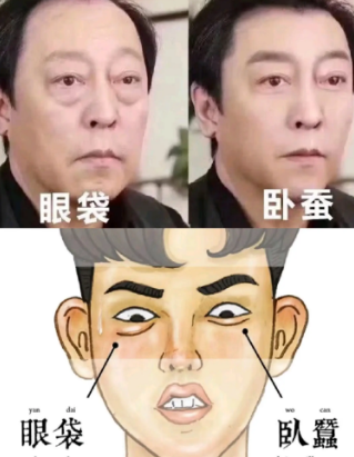 眼袋
