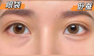 眼袋