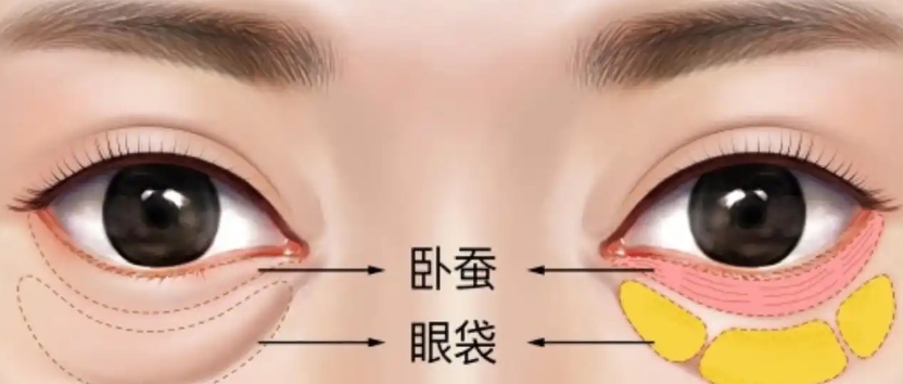眼袋