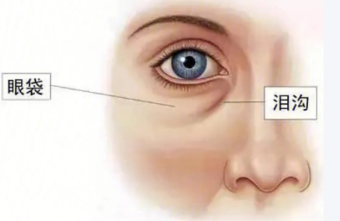 眼袋