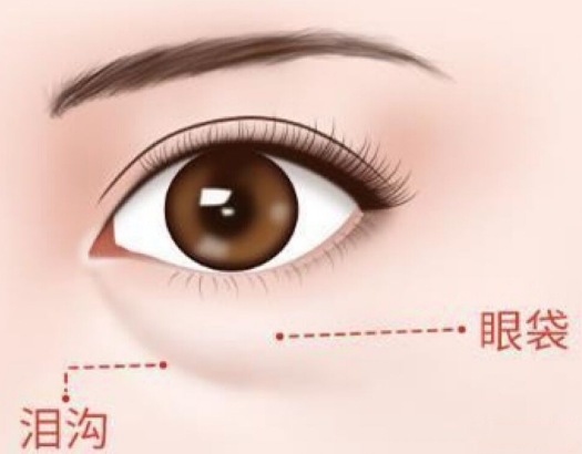 眼袋