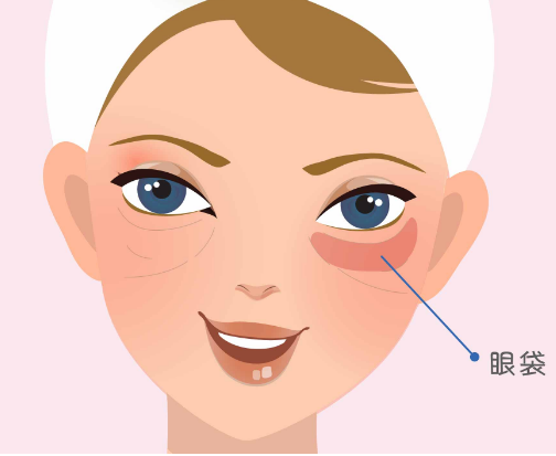 去眼袋手术