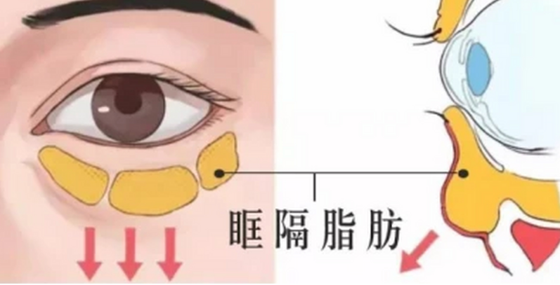 眼袋