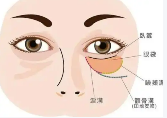 眼袋