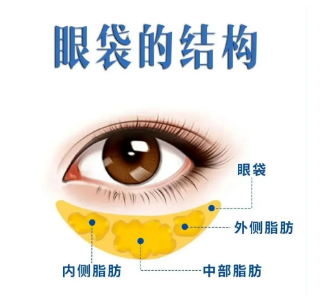 去眼袋手术