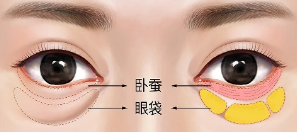 眼袋