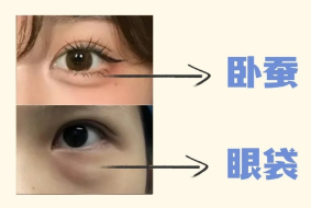 眼袋