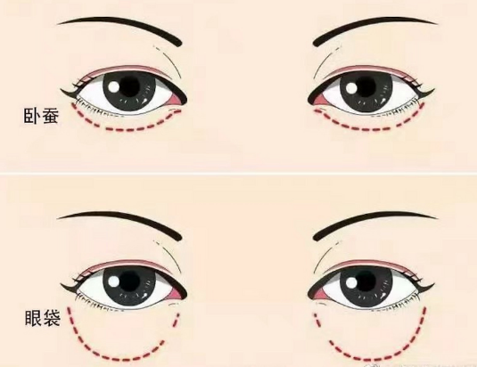 眼袋
