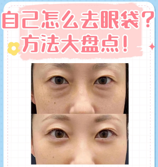 去眼袋手术