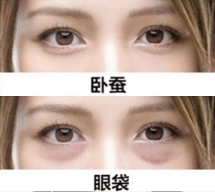 去眼袋手术