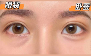 去眼袋手术