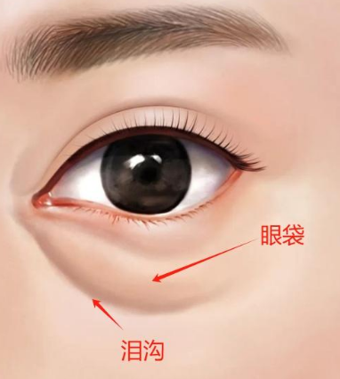 眼袋