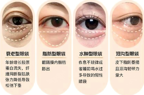 眼袋