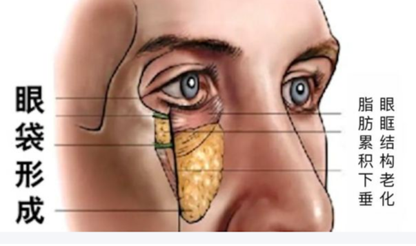 眼袋