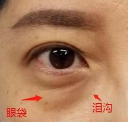 眼袋