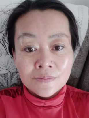 去眼袋手术