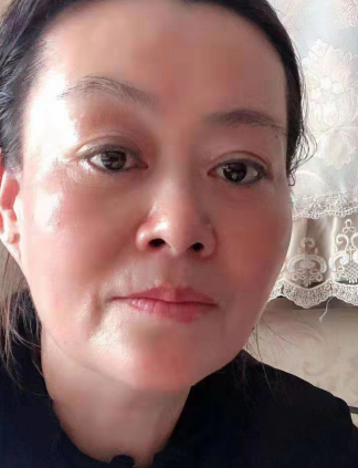 去眼袋手术