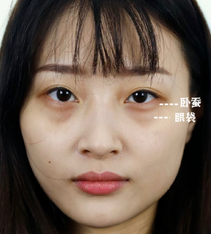 去眼袋手术
