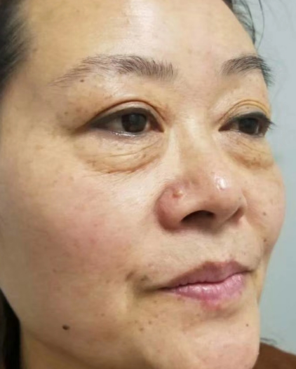 去眼袋手术