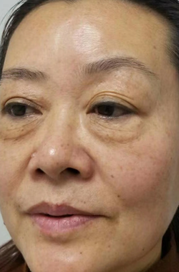 去眼袋手术