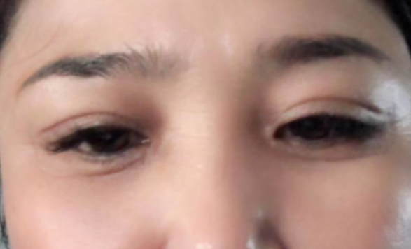 眼袋