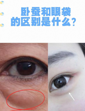 眼袋